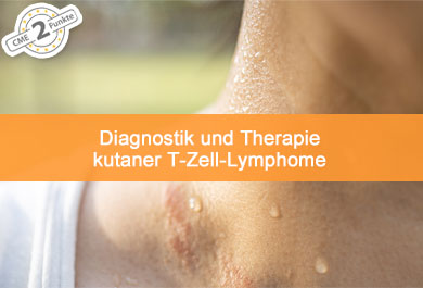 Diagnostik und Therapie kutaner T-Zell-Lymphome 