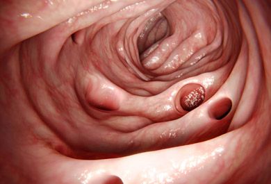 Update: Der Divertikelpatient in der Praxis