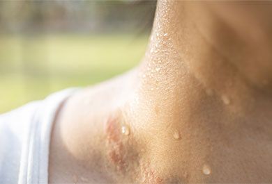 Diagnostik und Therapie kutaner T-Zell-Lymphome