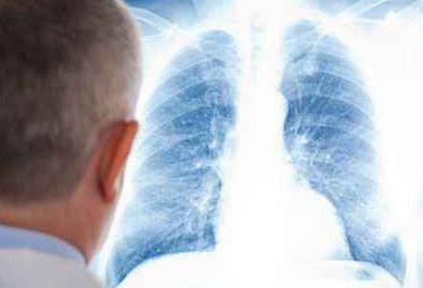 Leitliniengerechte Behandlung der Lungenembolie – ESC-Update 2014