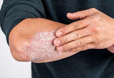 Moderne Immuntherapie der Psoriasis