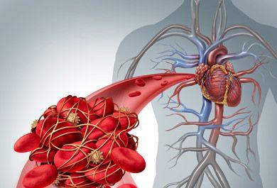 Orale Antikoagulation bei nvVHF - Wie ist die aktuelle Versorgungssituation – Was bleibt zu verbessern?