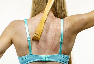 Diagnostik und Therapie des CKD-assoziierten Pruritus