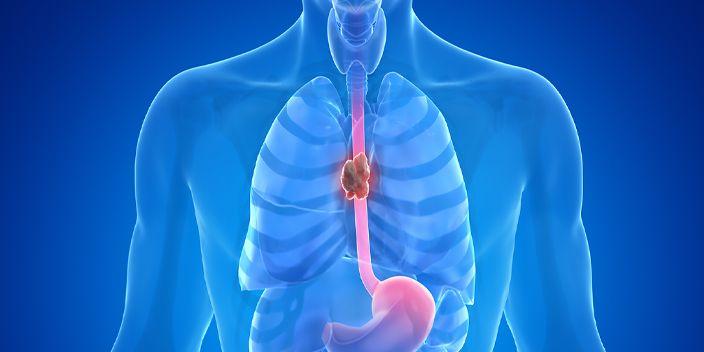 Update Immuntherapie beim fortgeschrittenen Plattenepithelkarzinom des Ösophagus
