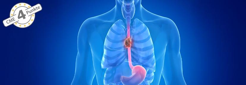 Update Immuntherapie beim fortgeschrittenen Plattenepithelkarzinom des Ösophagus