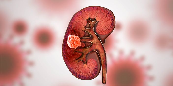 Das Nierenzellkarzinom: Von der Früherkennung bis zur modernen Systemtherapie