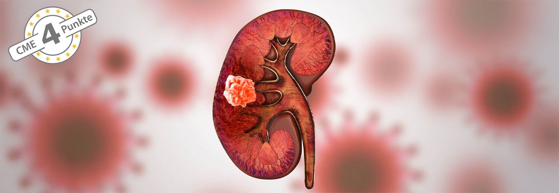 Das Nierenzellkarzinom: Von der Früherkennung bis zur modernen Systemtherapie