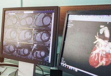 Perfusion und Late Gadolinium Enhancement im Kardio-MRT: Durchführung und typische Muster