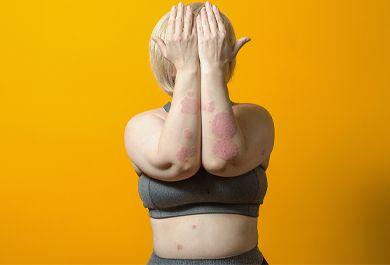 Psoriasis und Psychosoziale Belastung