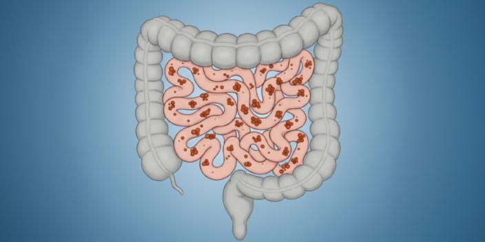 SIBO: Vom Pathomechanismus zur Praxis