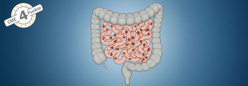 SIBO: Vom Pathomechanismus zur Praxis