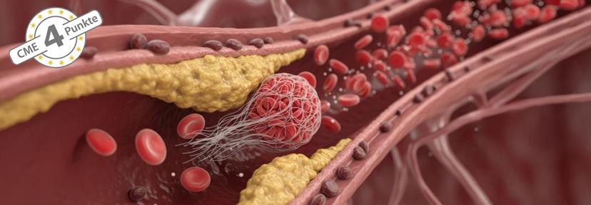 Thrombotische Mikroangiopathie nach Stammzelltransplantation
