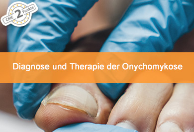 Diagnose und Therapie der Onychomykose