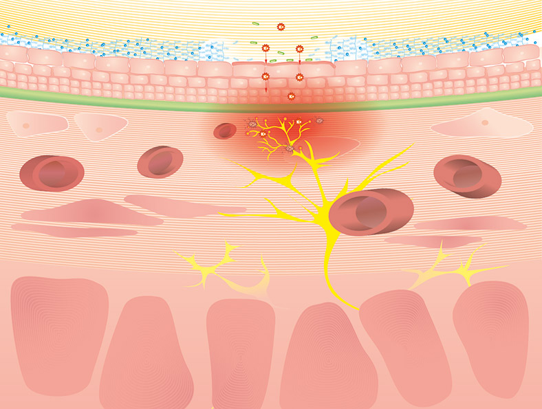 Geschaedigte Blasenwand Interstitielle Zystitis