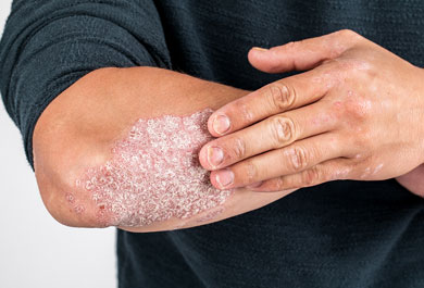 Moderne Immuntherapie der PSO