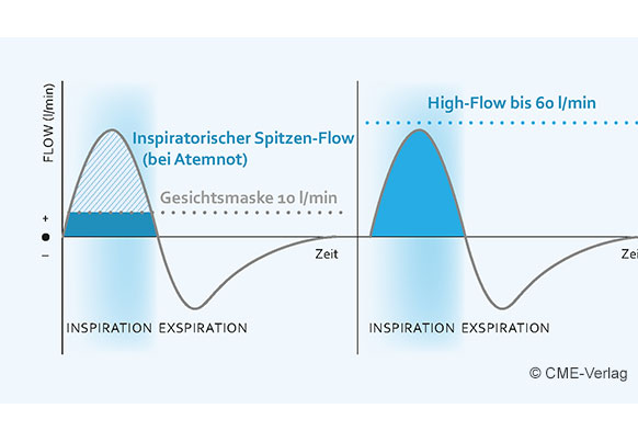 Verbesserte Oxygenierung unter nasaler High-Flow-Therapie (NHF)