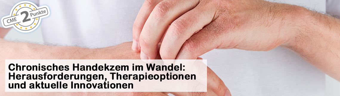Behandlung des mittelschweren bis schweren Chronischem Handekzems in Deutschland zur Verfügung.