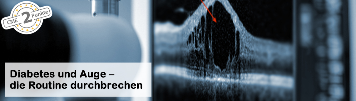 Diabetes und Auge – die Routine durchbrechen